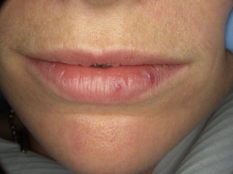 Teeth and Lips for Smile Makeover