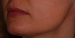 Photofacial treatment for Rosacea