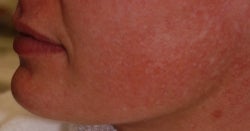 Photofacial treatment for Rosacea