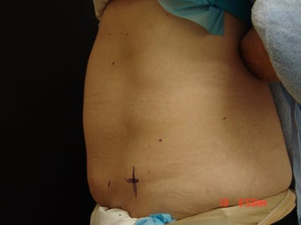 Coolsculpting Abdomen