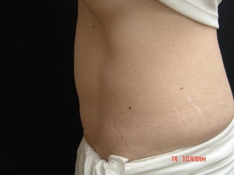 Coolsculpting Abdomen