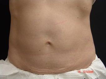 Coolsculpting Abdomen