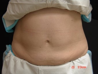 Coolsculpting Abdomen