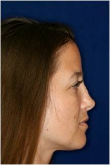 Non Surgical Rhinoplasty