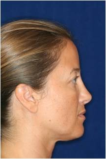Non Surgical Rhinoplasty