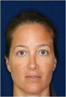 Non Surgical Rhinoplasty