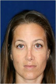Non Surgical Rhinoplasty