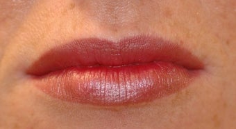 Juvederm for Lips