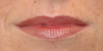 Juvederm for Lips