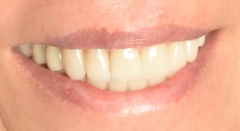 Full Mouth Reconstruction with Porcelain Crowns and Veneers