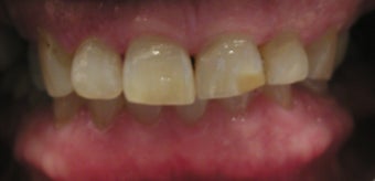 Full Mouth Reconstruction with Porcelain Crowns and Veneers