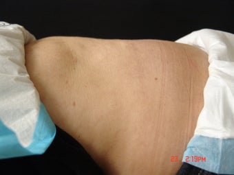 Coolsculpting Lower Abdomen