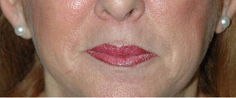 Lip Augmentation with Lip Lift for Natural, Refreshed Look