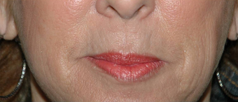 Lip Augmentation with Lip Lift for Natural, Refreshed Look