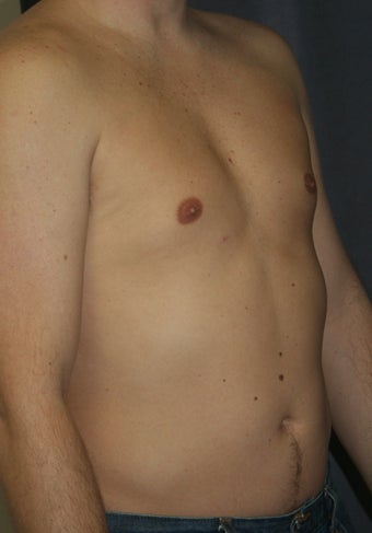 Liposuction of the male chest and abdomen