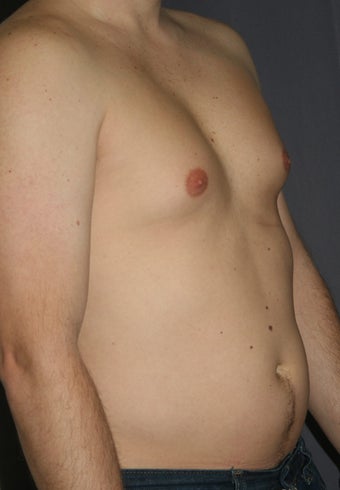 Liposuction of the male chest and abdomen