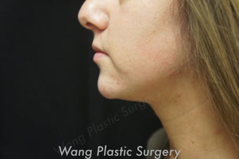 Chin Augmentation with Radiesse filler
