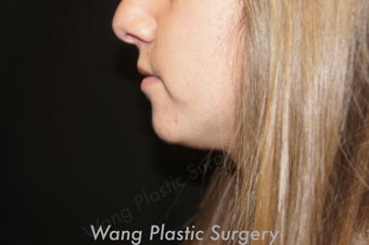Chin Augmentation with Radiesse filler