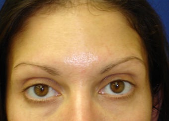 Forehead Lines