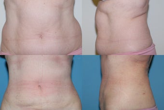 Smartlipo  love handles