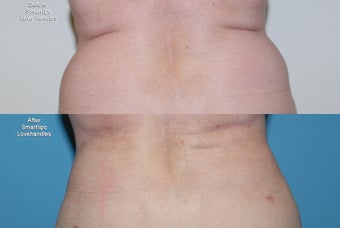 Smartlipo  love handles