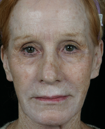 Pearl Fractional