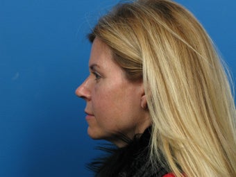 Revision Rhinoplasty