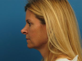 Revision Rhinoplasty