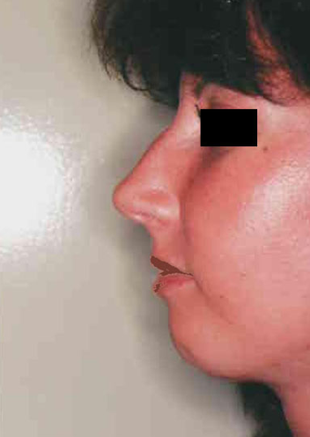 Chin Implant
