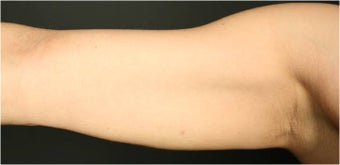 SmartLipo MPX