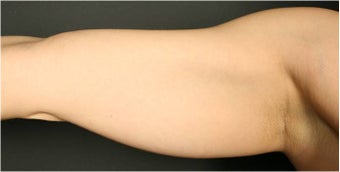 SmartLipo MPX