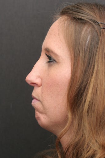 30 Year Old Young Lady Treated with Botox for the Creases of her chin