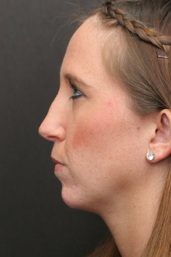 30 Year Old Young Lady Treated with Botox for the Creases of her chin