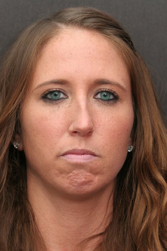 30 Year Old Young Lady Treated with Botox for the Creases of her chin