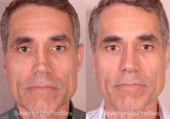Revision Rhinoplasty