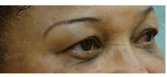 Woman in her 60s treated for dark circles and fine lines with Enerpeel EL eyelid peel