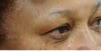 Woman in her 60s treated for dark circles and fine lines with Enerpeel EL eyelid peel