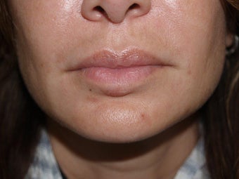 Extensive repair of scarring and deformity as a result of silicone and BioPolymer lip injections