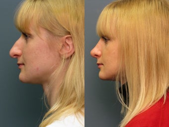 Nose Surgery