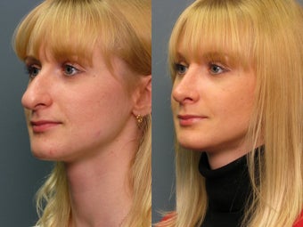 Nose Surgery