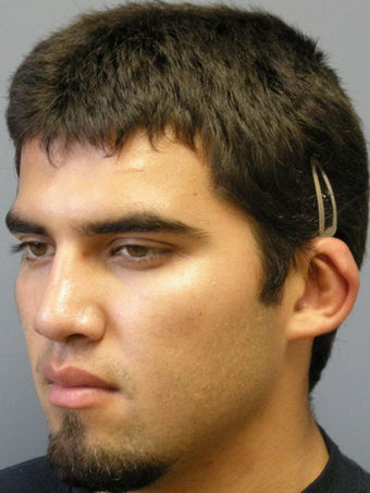 Otoplasty/Ear Surgery