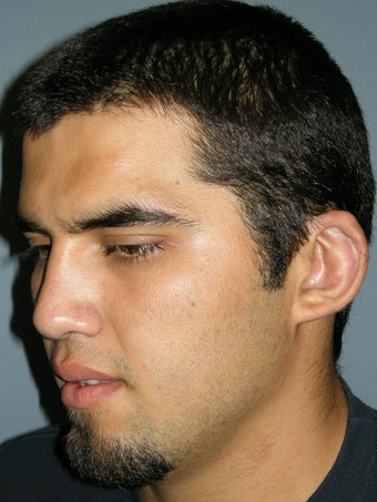 Otoplasty/Ear Surgery