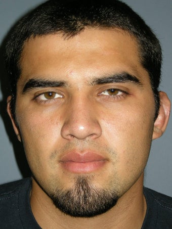 Otoplasty/Ear Surgery