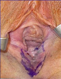 Vaginoplasty Before and After in the OR