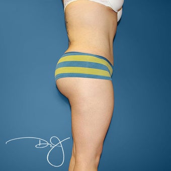 Fat Transfer to Buttock