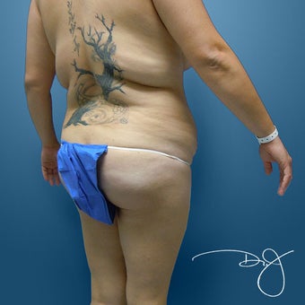 Fat Transfer to Buttock