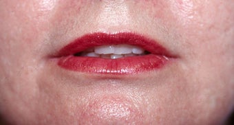Lip Augmentation