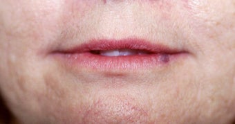 Lip Augmentation