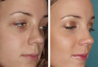 4 female who broke her nose in an automobile accident