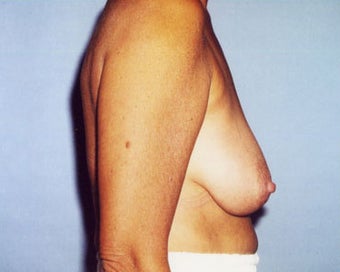 Breast Lift Increases Areolar Height for 45 Year Old Woman